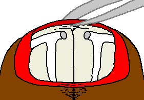 Acarine diagnosis, tweezer removal of collar