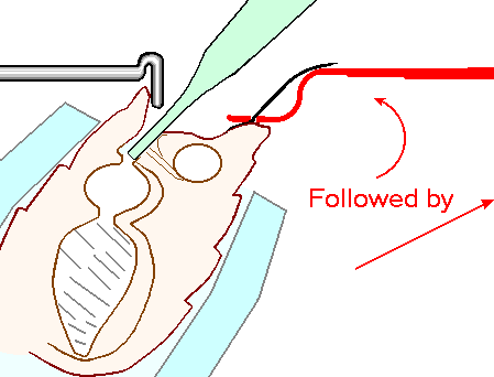 Perforated Sting Hook method