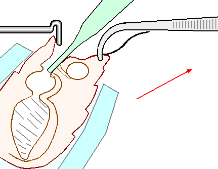 Tweezer II Method